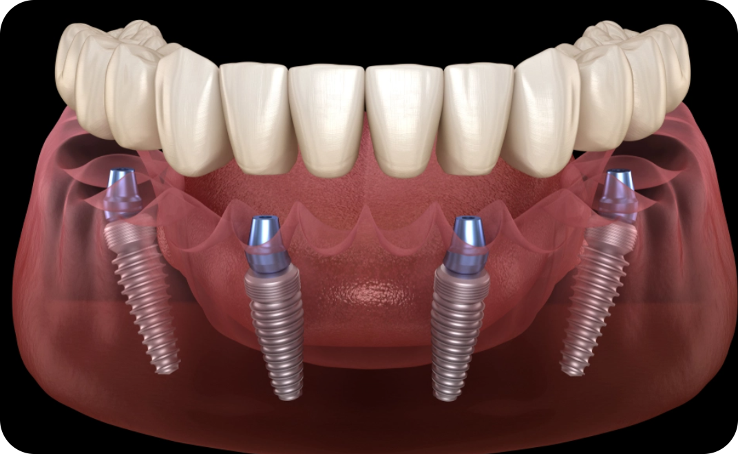 All-on-4 Implants