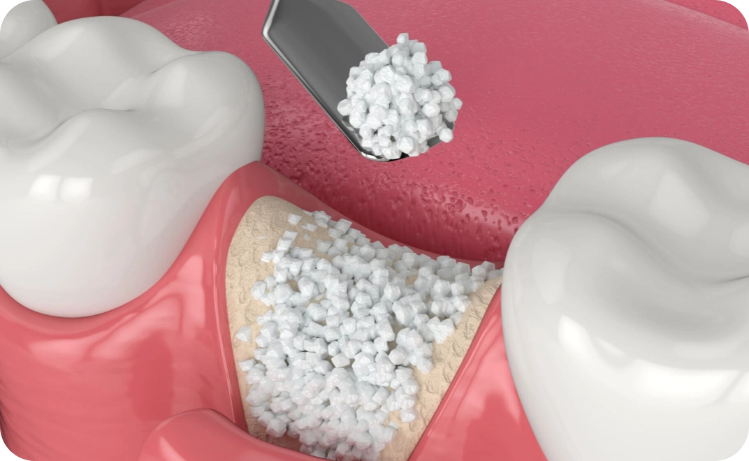 Bone Grafting
