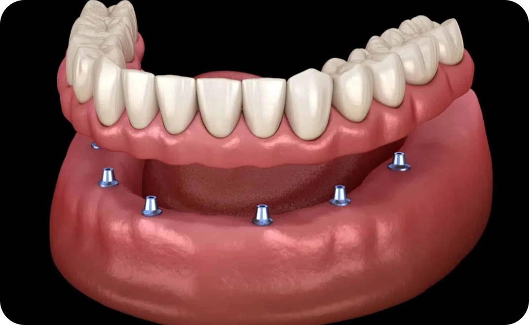 Implant-Supported Dentures