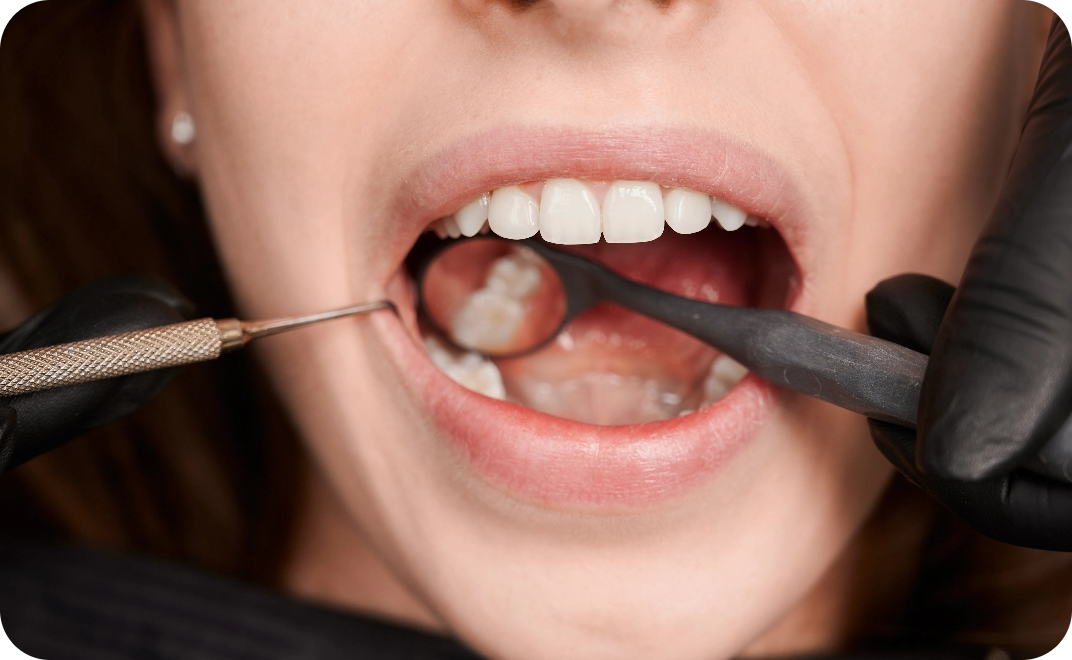 Wisdom Teeth Removal